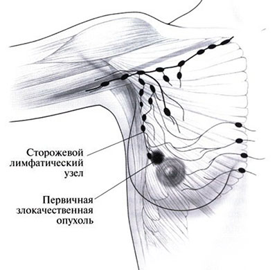 Опухоль и лимфоузлы Опухоль и лимфоузлы